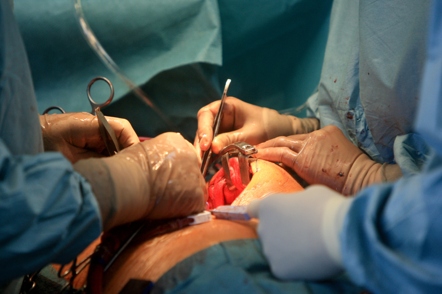 Aneurisma dell'aorta addominale - Clinica Vascolare