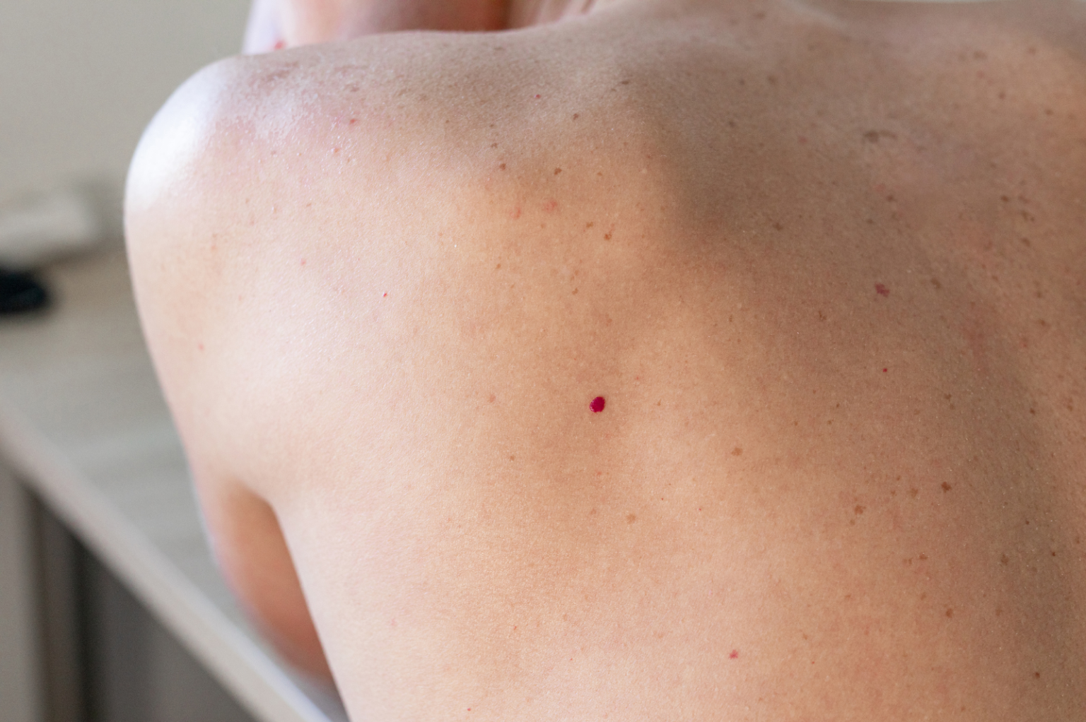 Angiomi e malformazioni vascolari - Clinica Vascolare
