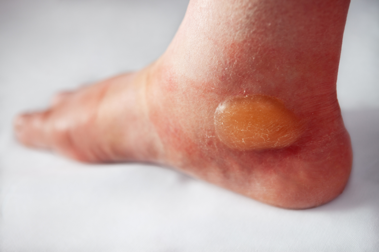 Linforrea - Clinica Vascolare