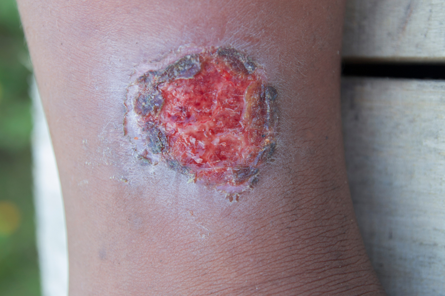 Ulcere linfatiche - Clinica Vascolare