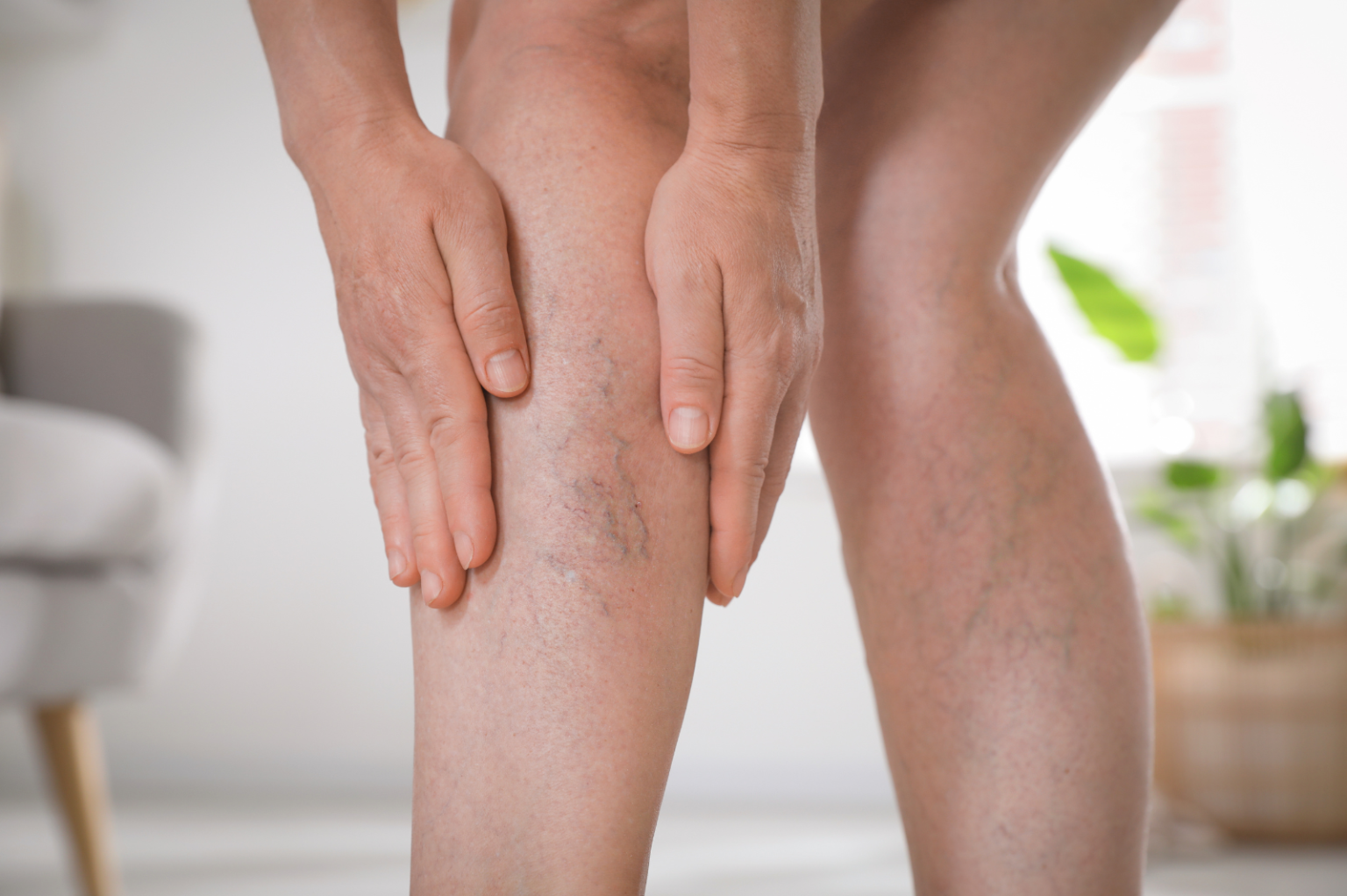 Varici degli arti inferiori - Clinica Vascolare